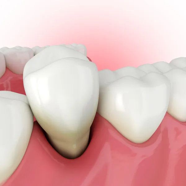 Tooth Extraction image